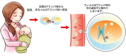 HTLV-1は母子感染ルートが最も多いです