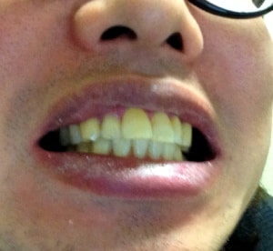 半年間、歯間ブラシを続けた歯（醜い写真でごめんなさい！）