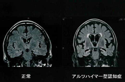 アルツハイマー型認知症のMRI画像