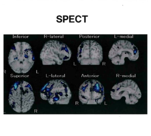 血管性認知症のSPECT画像