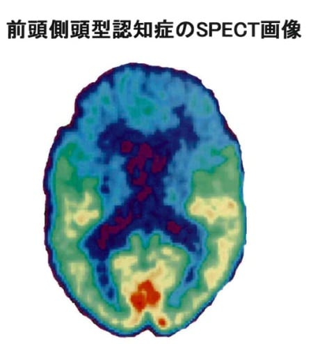 前頭側頭型認知症のSPECT画像