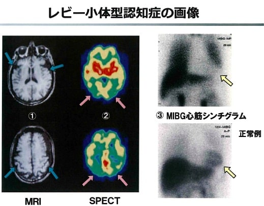 レビー小体型認知症の画像診断