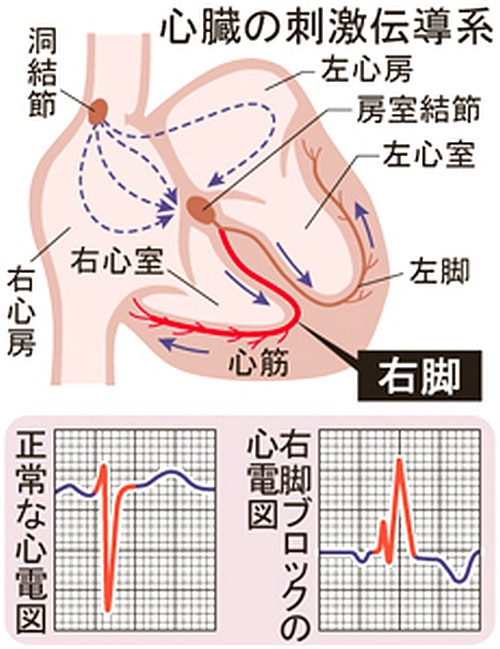 心臓の3つの信号の流れと右脚ブロックの心電図